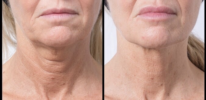 Neck fillers